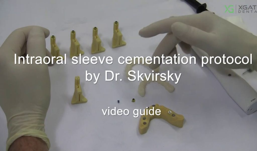 Intraoral sleeve cementation protocol, video guide