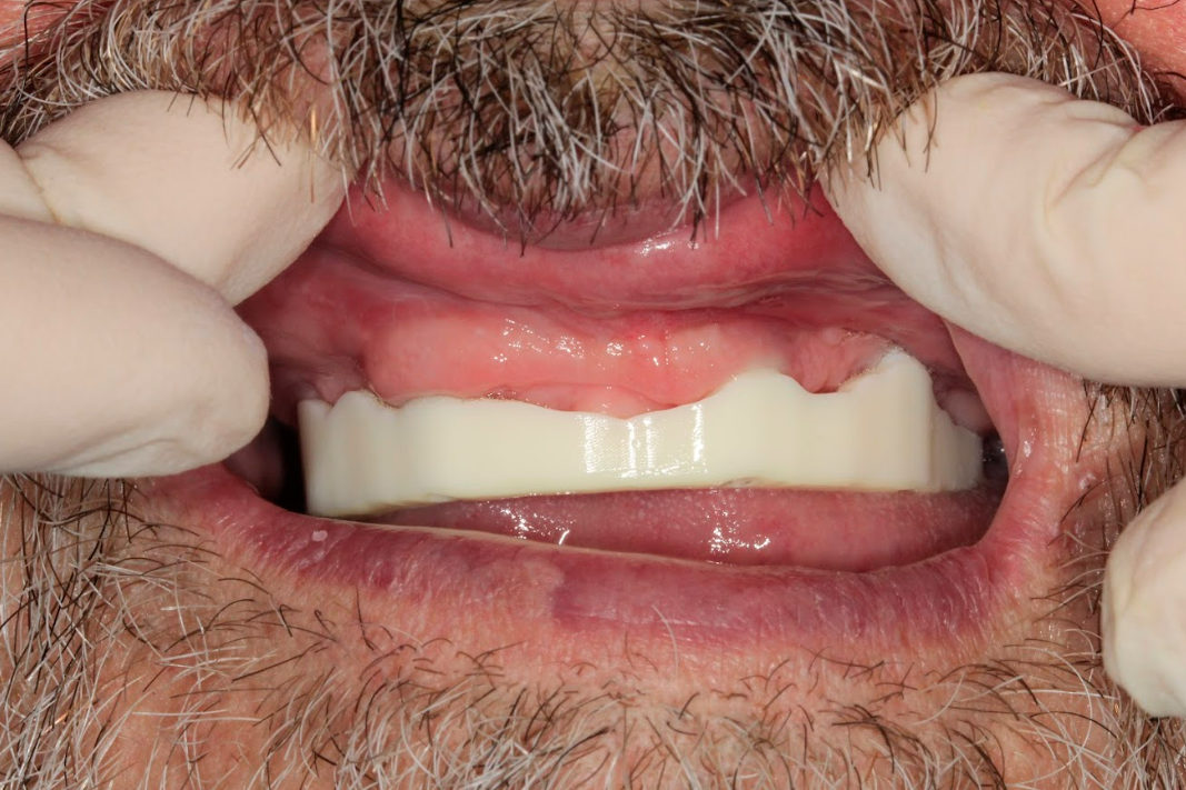 Intraoral try-in of the resin verification jig to check for a passive fit on the XGATE MUAs.