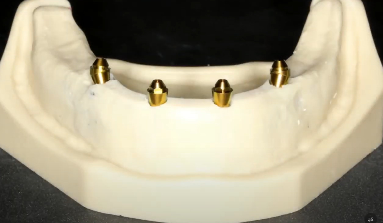 Study model with installed implants and multi-unit abutments