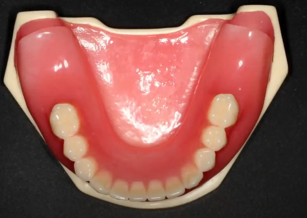 Model of a jaw with a tissue-supported removable denture