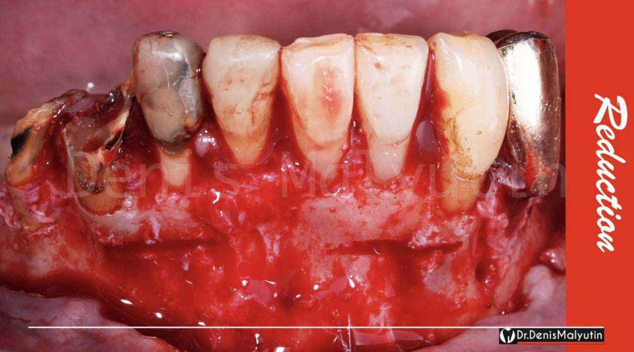 Clinical view of mandibular anterior teeth showing severe gingival recession and exposed roots