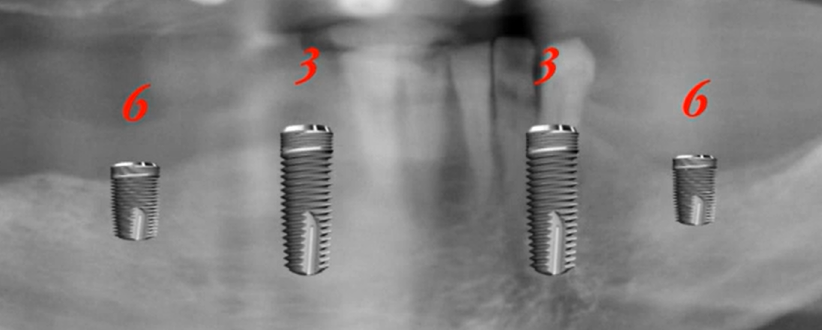 Panoramic radiograph showing four dental implants positioned in lower jaw with numbered teeth