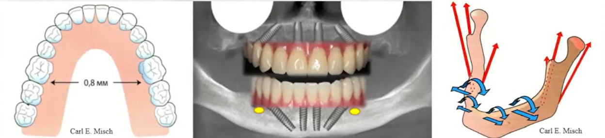The principle of mandibular deformation and its implications for prosthetics supported by anteriorly placed implants