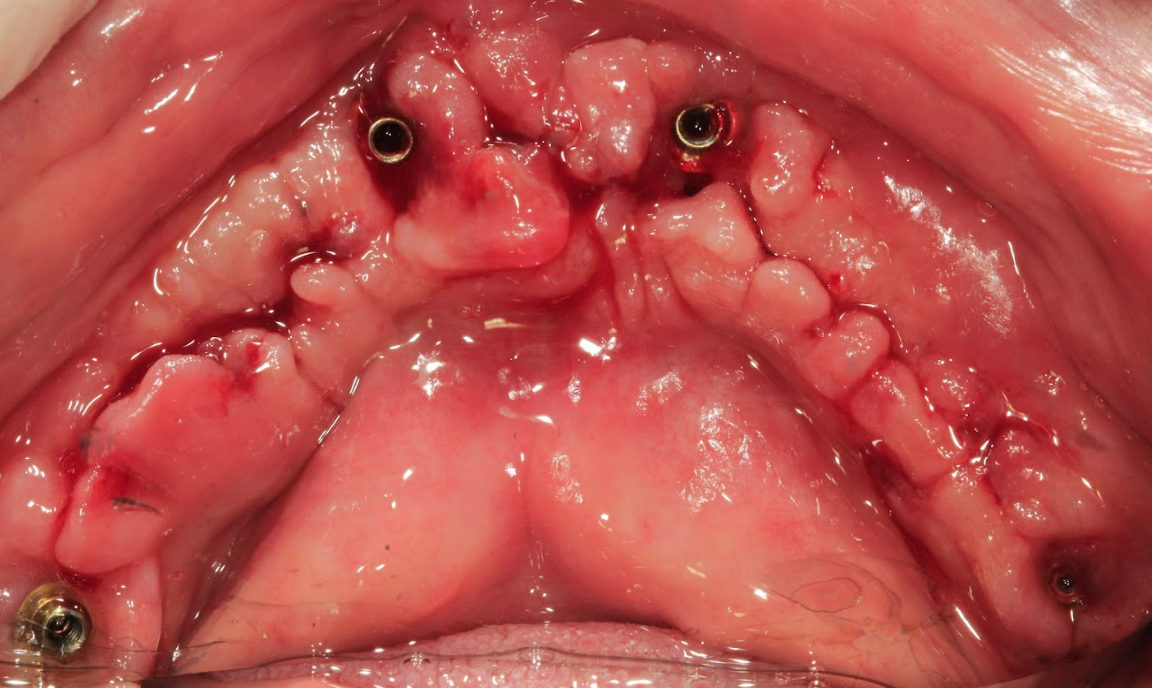 An intraoral photo showing the healthy, healed soft tissues of the mandible before the final prosthesis is delivered.