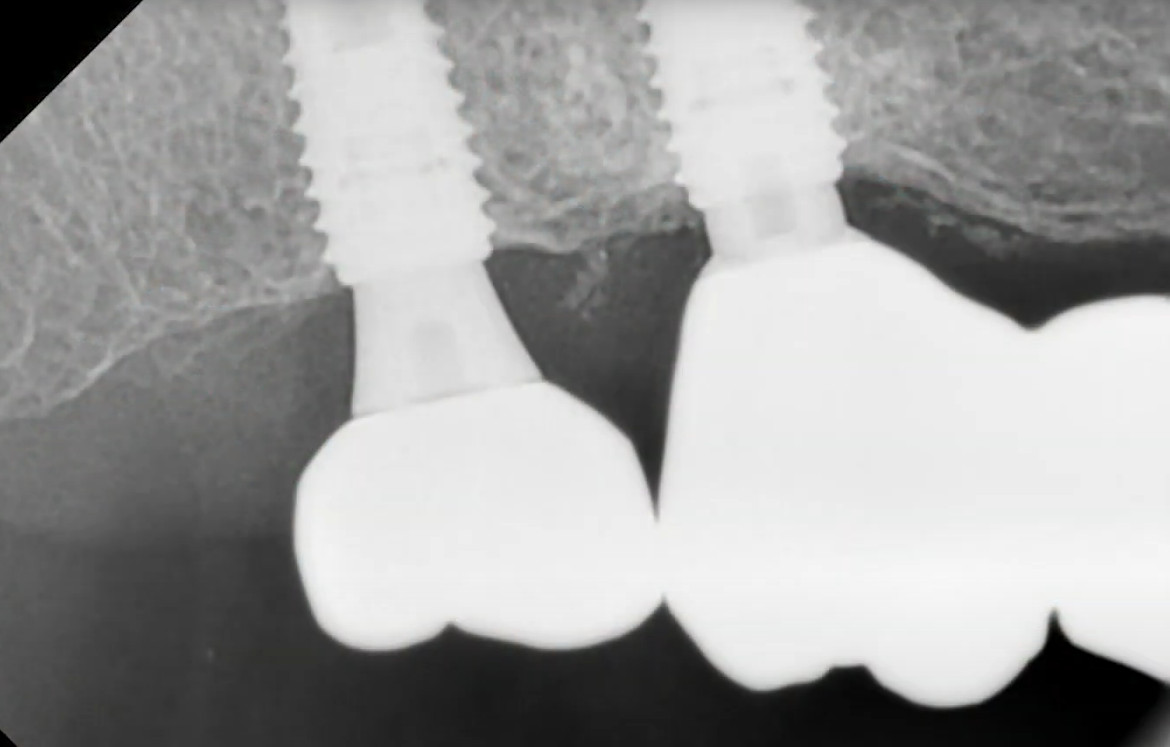 Follow-up x-ray showing stabilized dental implant with healthy surrounding bone tissue
