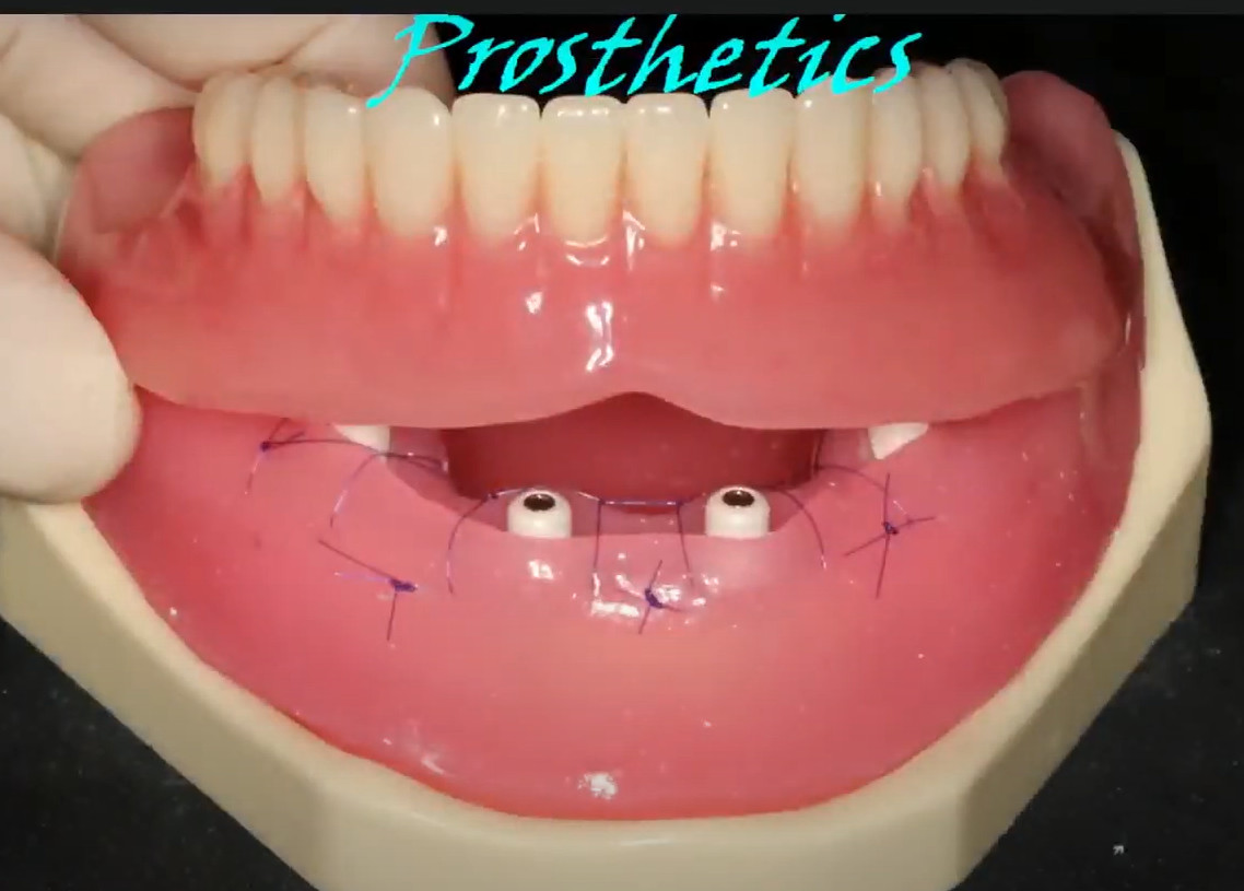 Beginning the modification of a removable denture