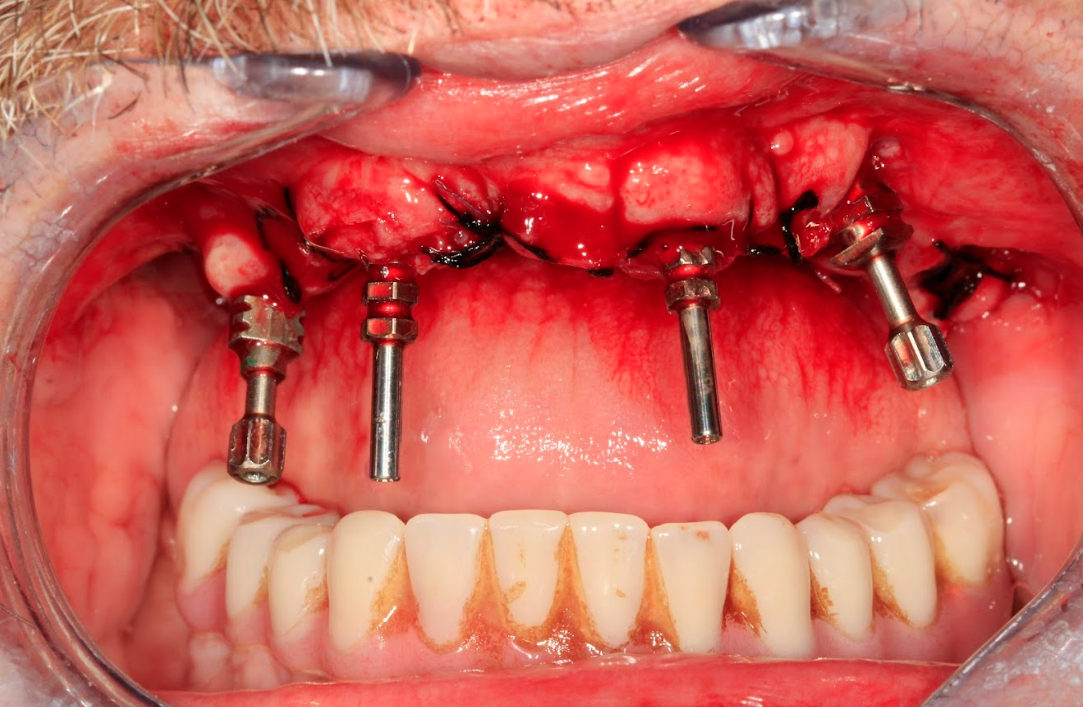 Impression transfers placed on the XGATE multi-unit abutments to take the initial impression.