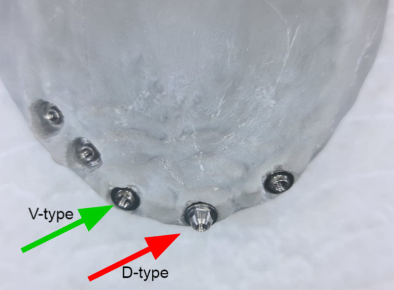 Comparison of the interface height of multi-unit abutments V-type and D-type on a jaw model