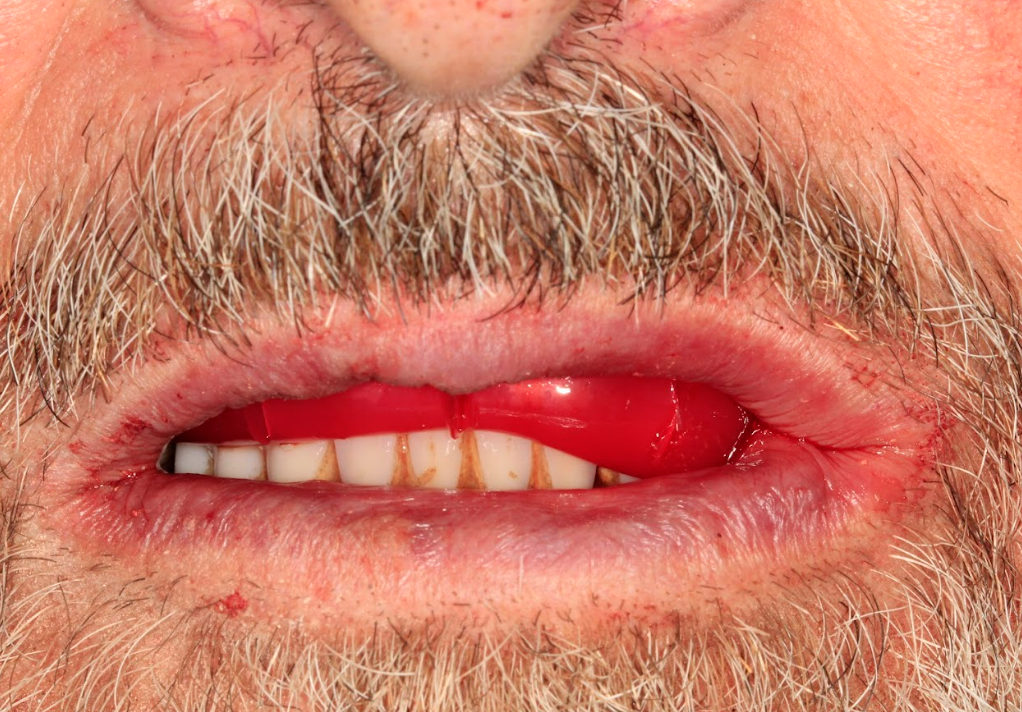 Patient’s bite registered using a wax rim to record the vertical dimension of occlusion.