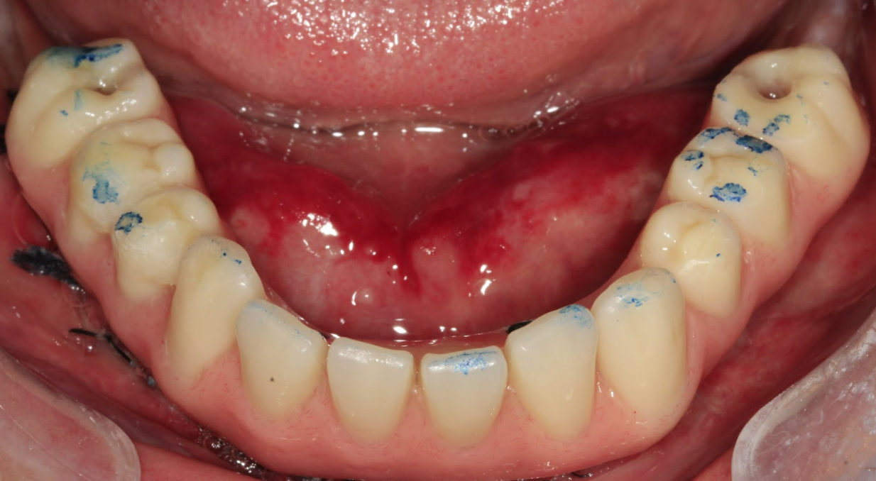 A clinical photo showing the use of articulating paper to check and adjust the bite (occlusion) on the final mandibular prosthesis.