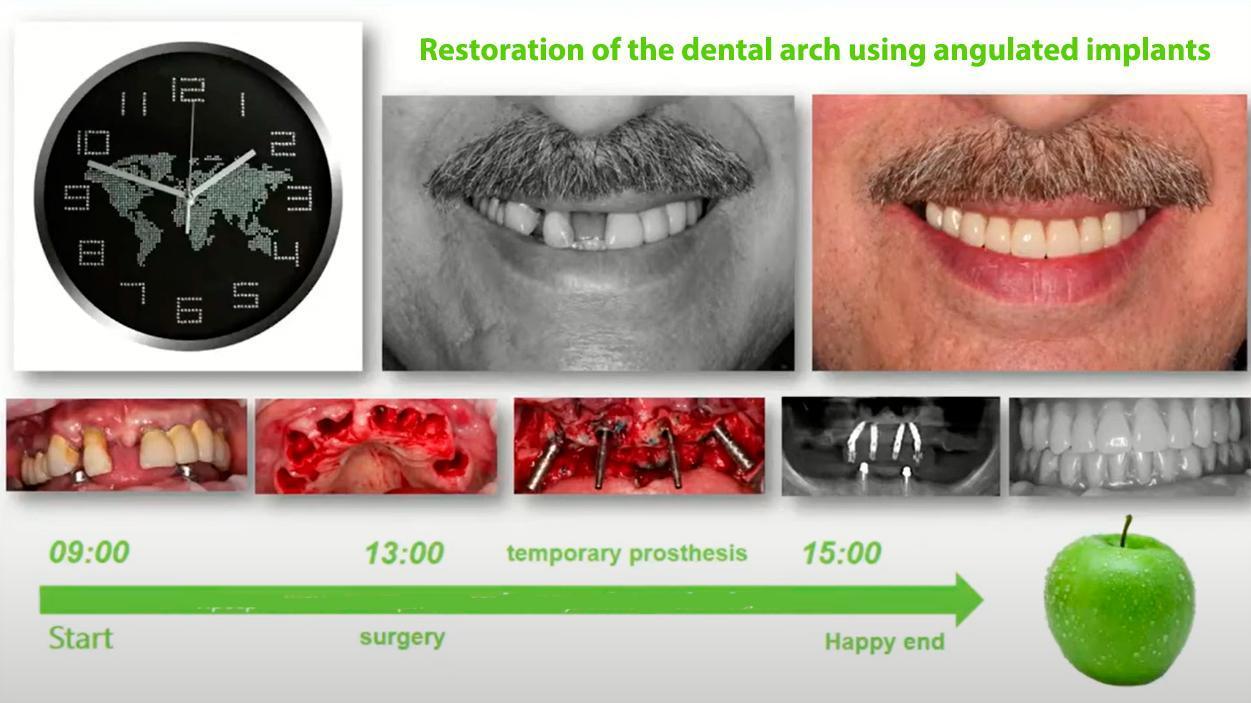 Before and after photos of a patient's smile, showing missing teeth replaced with a full upper arch prosthesis.