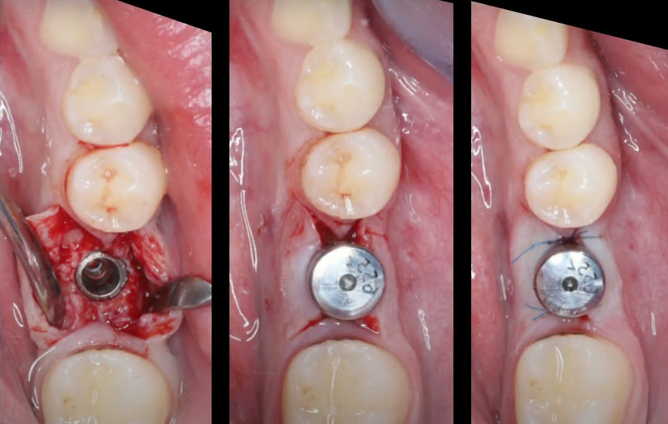 One-stage implantation protocol