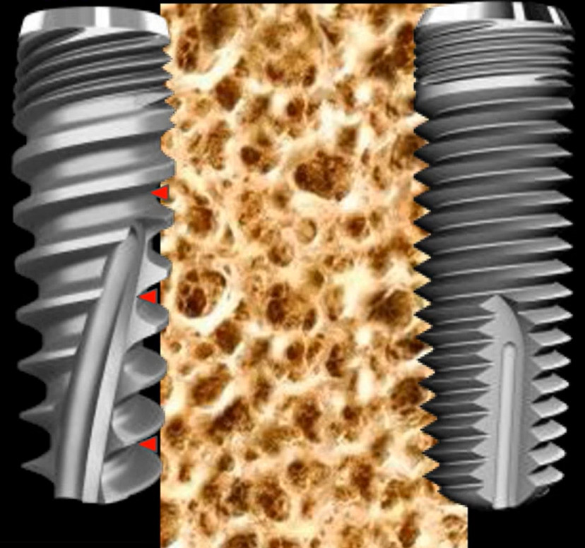 Cross-section showing bone integration failure between two dental implants with different thread designs