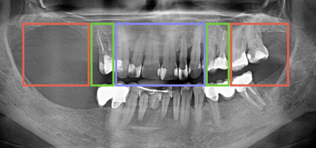 Panoramic dental X-ray with colored zones marking bone tissue analysis areas for implant planning