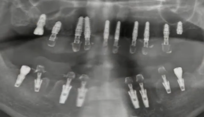 Panoramic dental x-ray showing multiple dental implants placed in upper and lower jaws