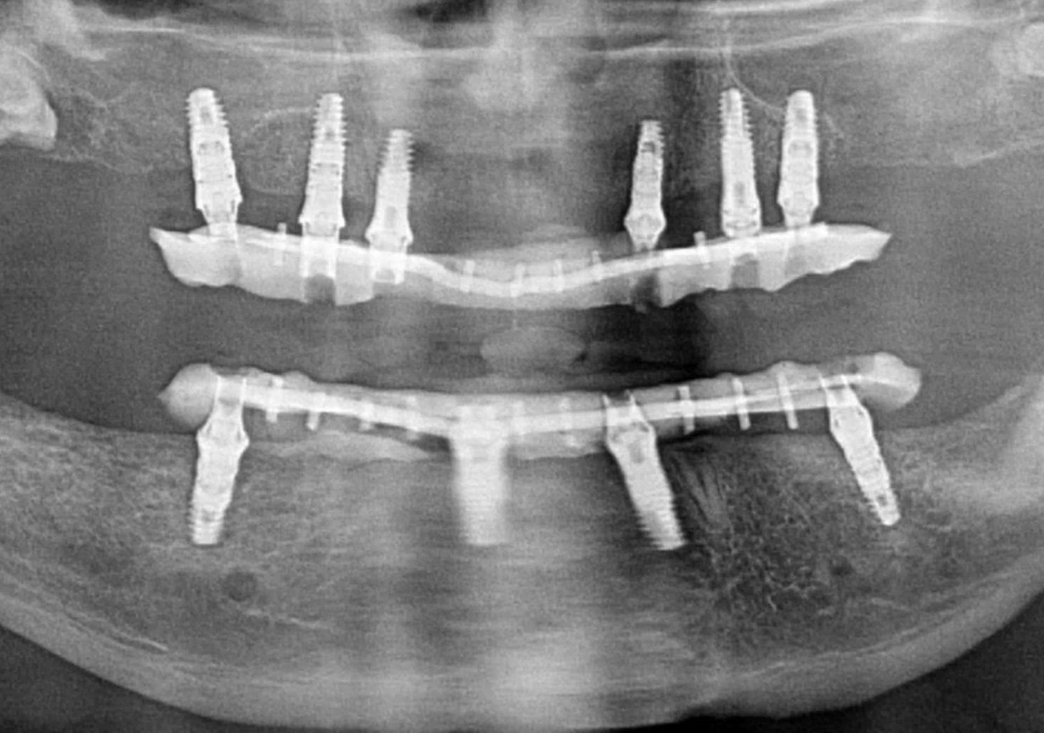 Panoramic X-ray showing dental implant supported full arch restoration in maxilla and mandible