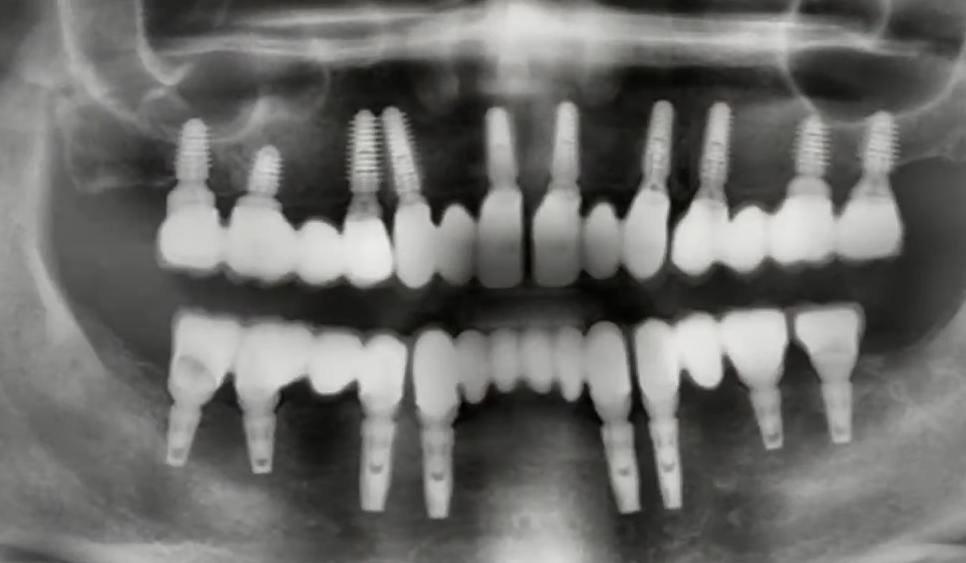 Panoramic dental X-ray showing multiple dental implants in upper jaw with natural teeth below