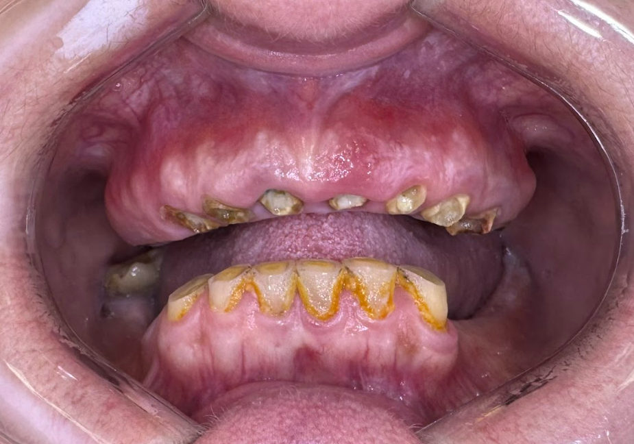 Intraoral view of a 57-year-old patient’s maxilla and mandible before full rehabilitation, showing damaged and missing teeth.