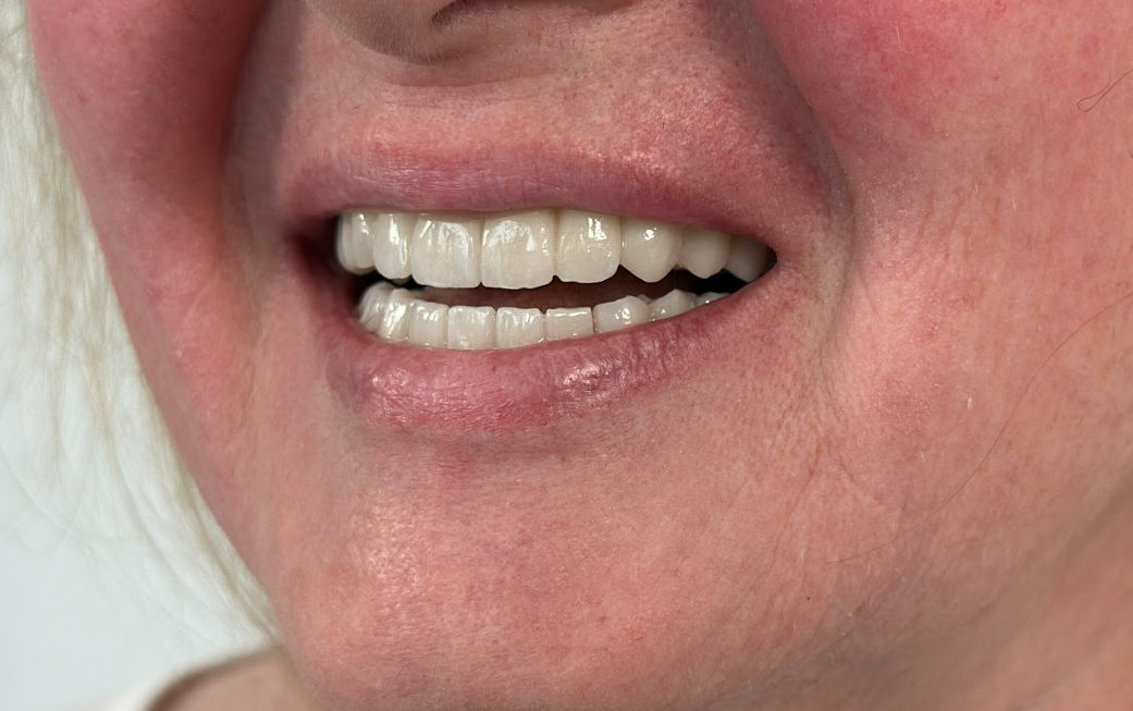 A close-up photograph of a patient’s happy and healthy smile, showcasing the final aesthetic result of a full-mouth dental restoration