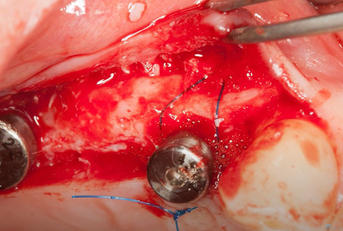 Periosteal envelope technique for bone grafting around dental implant defect