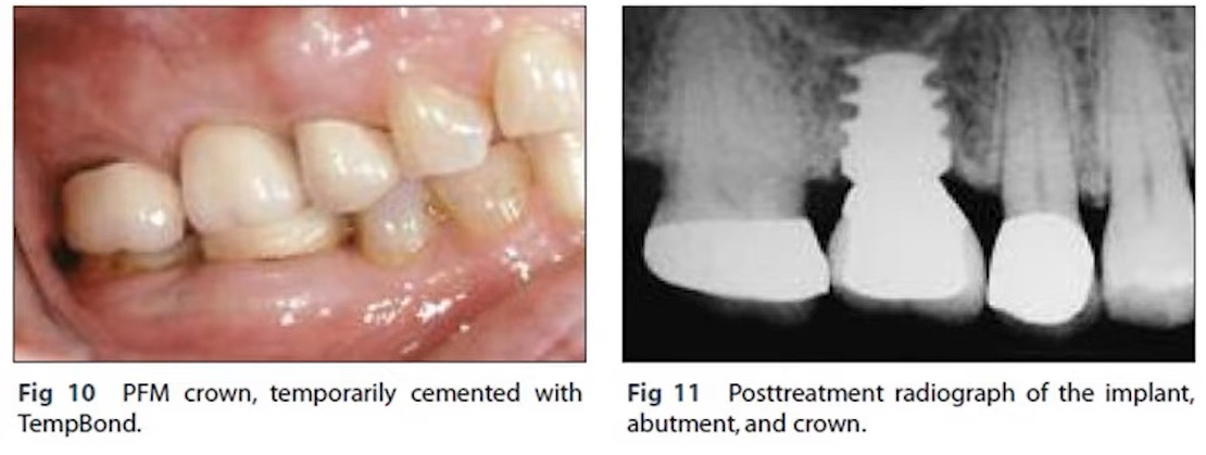 PFM crown temporarily cemented with radiograph showing dental implant abutment and crown placement