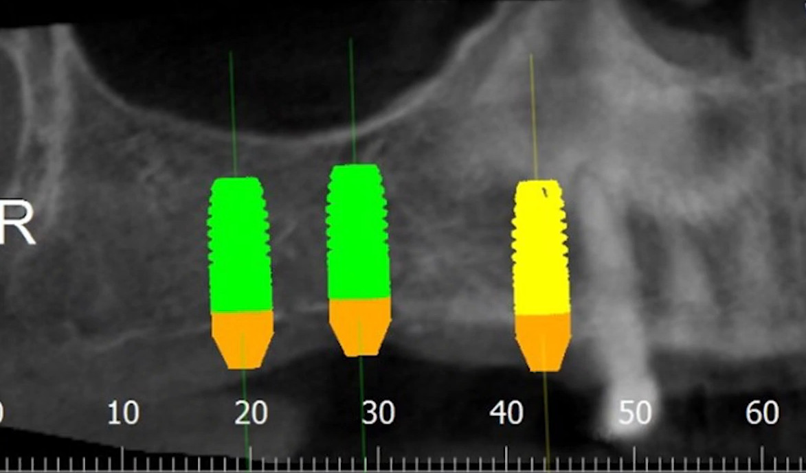 3D planning view showing placement of dental implants in upper jaw
