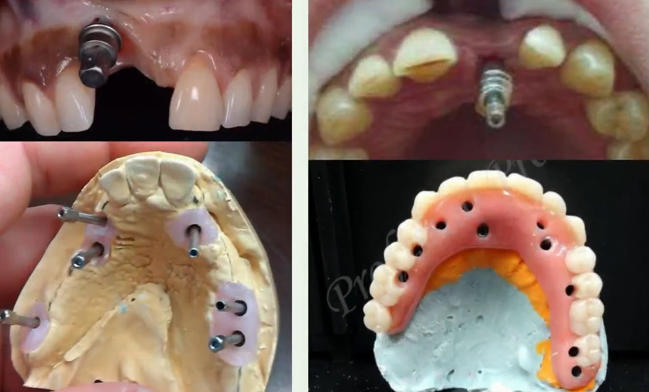 Examples of poor dental implant placement showing technical errors