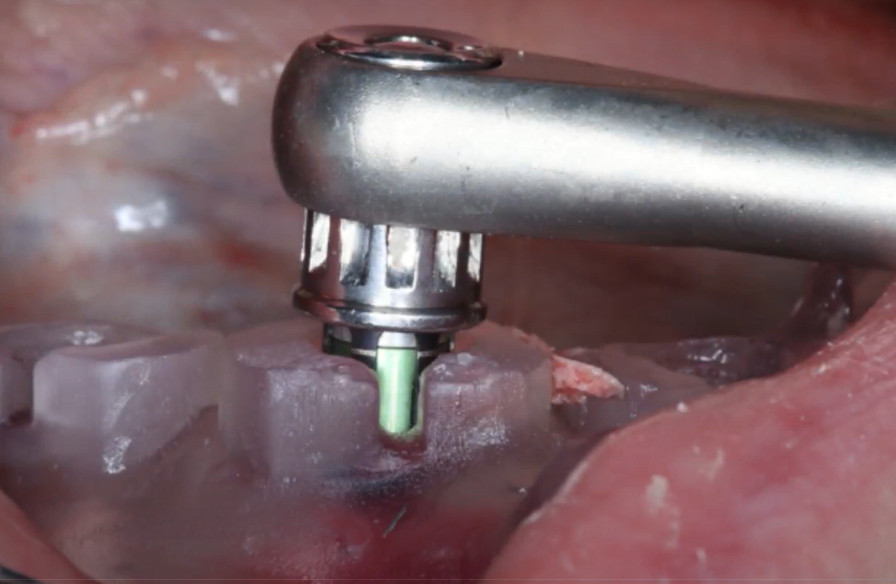 precise interface alignment: the silver mark aligns with the template slot, and a green indicator on the driver's moving part confirms correct placement YouTube / Dr. Kamil Khabiev / Dental Guru Academy
