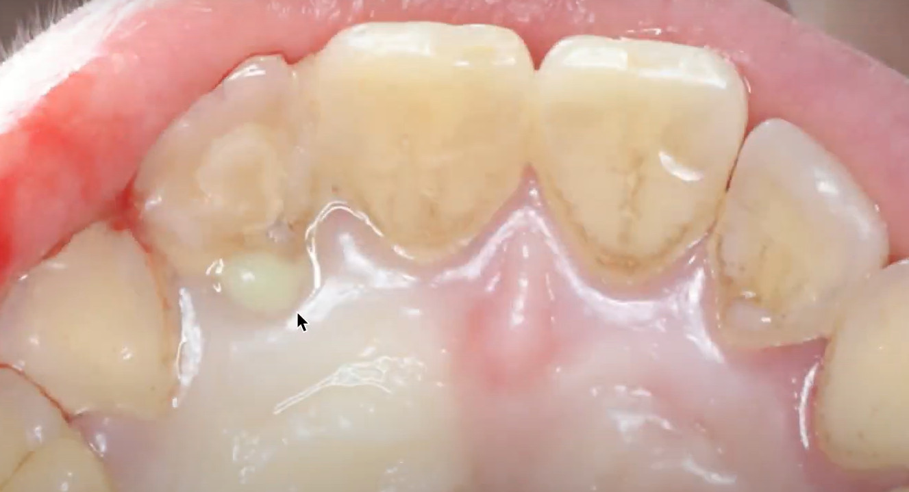 Discharge of pus from the palatal side of the problematic tooth