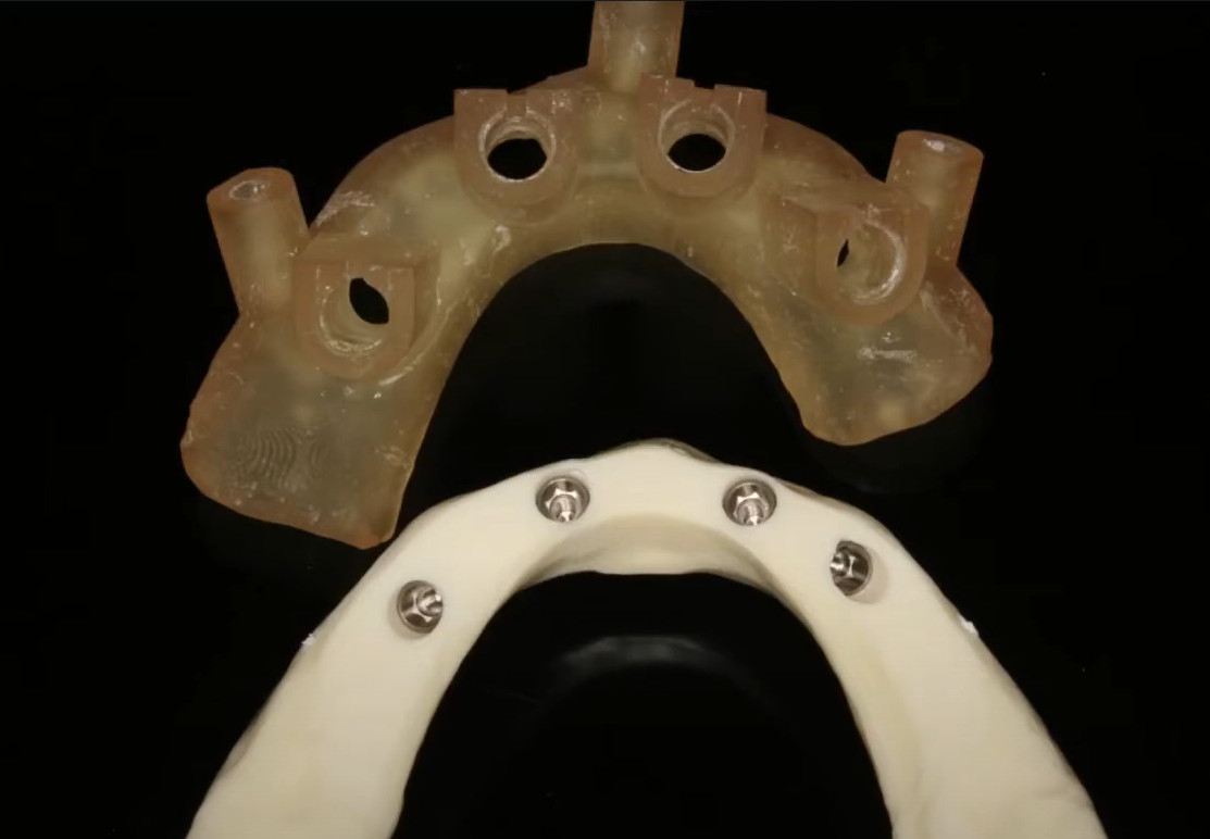 Study model of a jaw with placed implants and an R2Gate surgical template