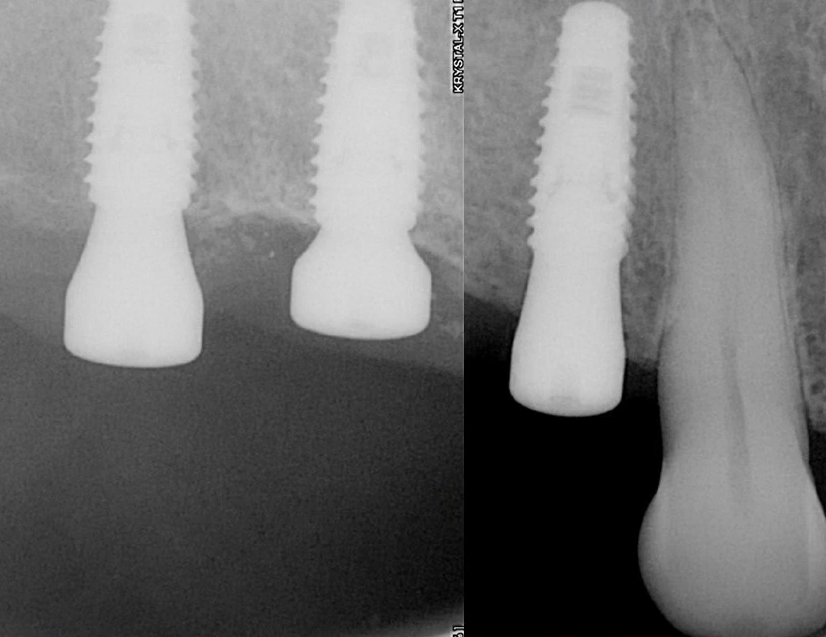 Post-operative radiograph showing stable dental implant integration after three months