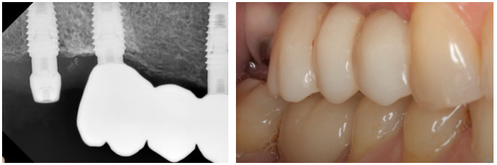 Radiograph and clinical view showing dental implant healing after six months