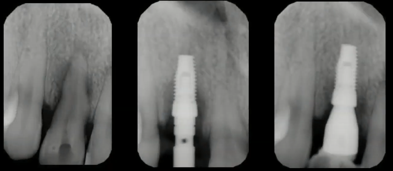 A series of radiographs from the initial situation