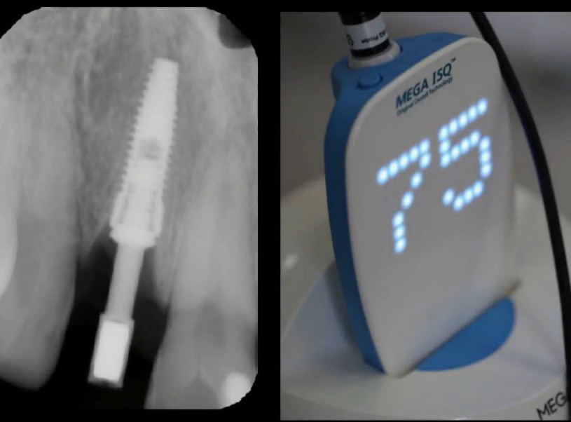 Mega-ISQ readings during primary implant stability assessment YouTube / Dr. Kamil Khabiev / Dental Guru Academy