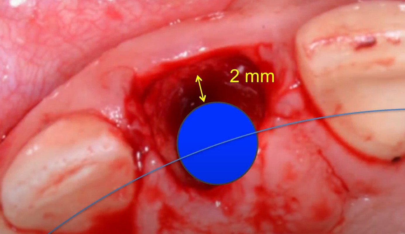 Recommended 3D implant positioning for immediate implantation