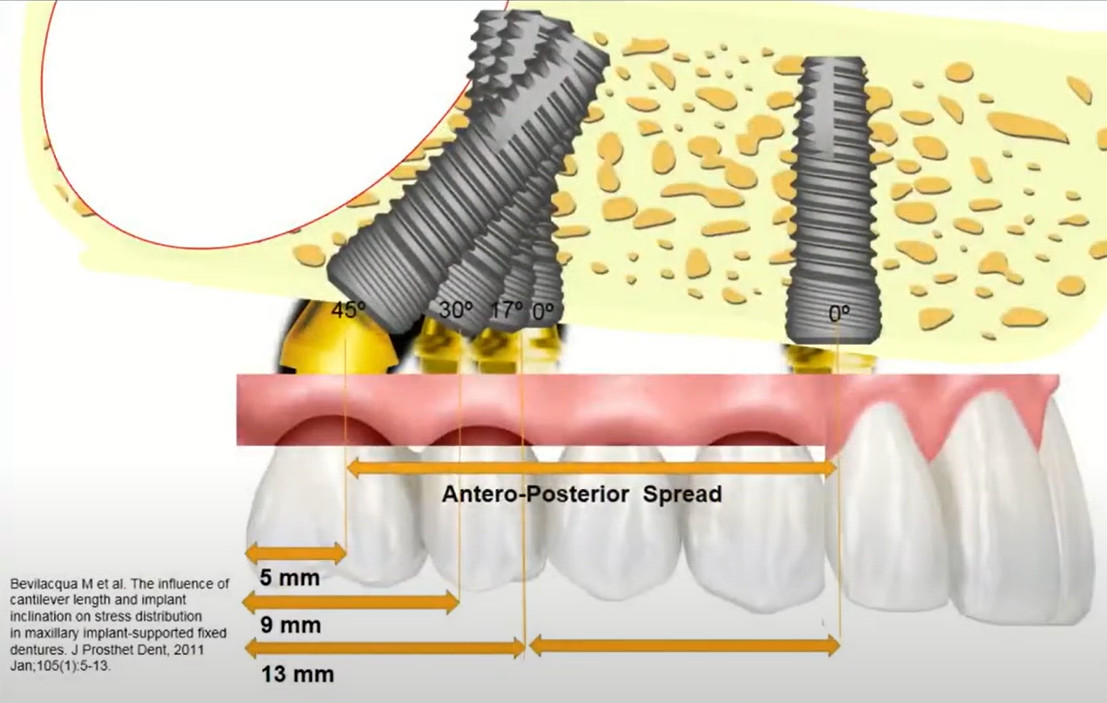 Reducing the cantilever length of the prosthesis by increasing the implant's angle of inclination (maxilla)