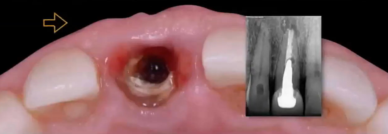 Occlusal close-up of the fractured root remnant in the socket before debridement and implant placement.