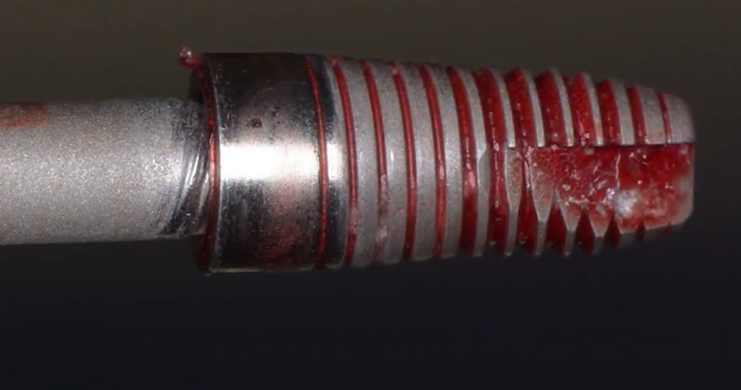 Retrieved spinning dental implant showing tissue remnants during stability testing procedure