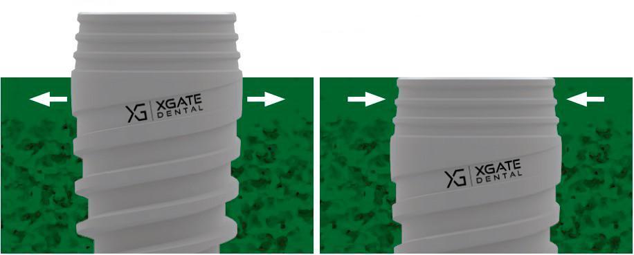 XGATE dental implant showing reverse taper neck with pressure distribution arrows in bone
