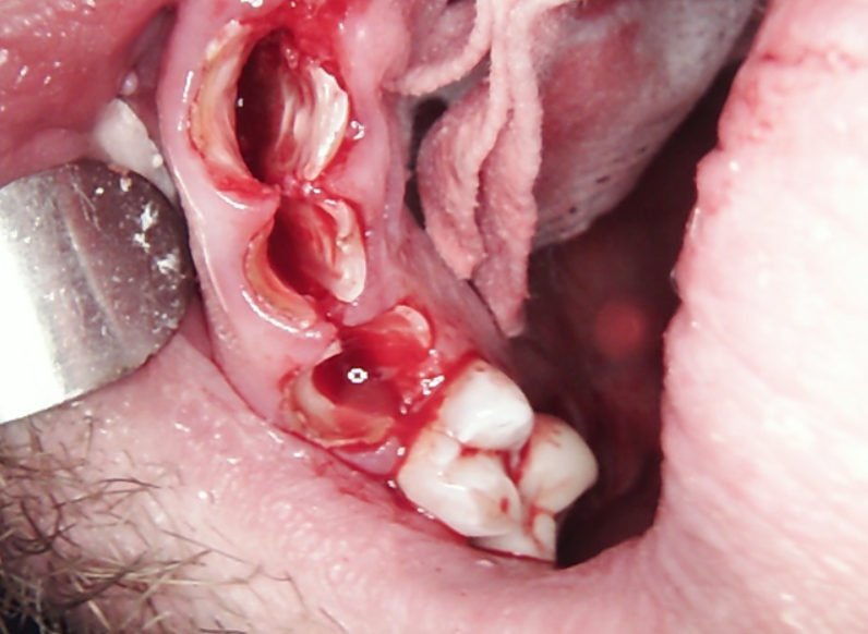 Clinical view demonstrating the preservation of buccal and palatal bone walls using the root shield technique.