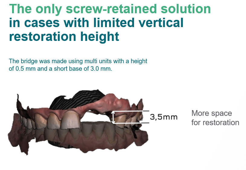 Digital model showing screw-retained dental implant bridge with 3.5mm vertical restoration space and multi-unit abutments