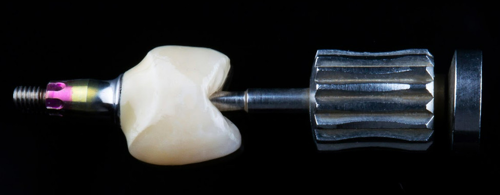 Crown with screw-retained abutment (single defect) (image from Shutterstock)