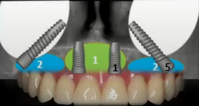 Severe atrophy requiring Zygomatic implants