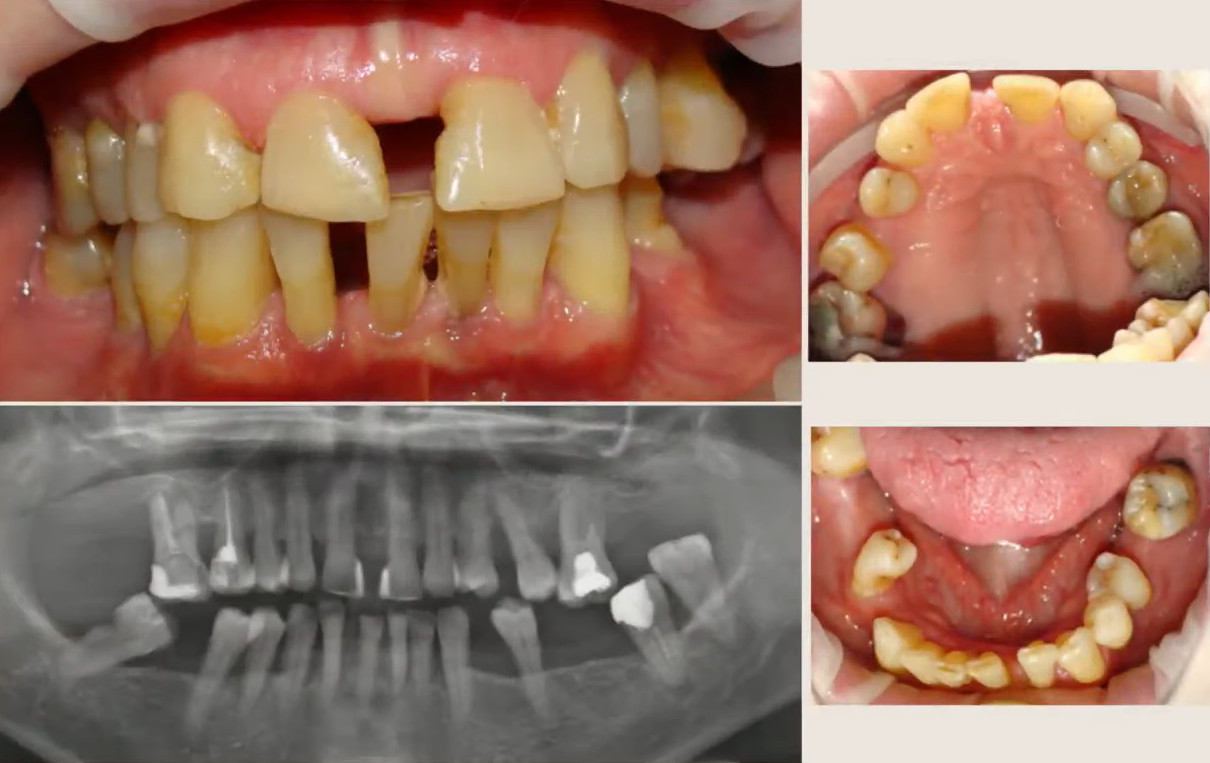 Severely decayed and discolored teeth with panoramic x-ray showing extensive bone loss before extraction