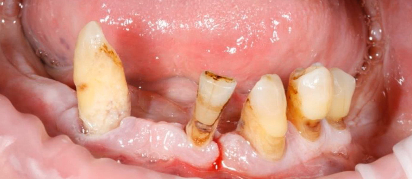 Severely damaged and discolored lower teeth with visible decay requiring extraction before dental implant placement