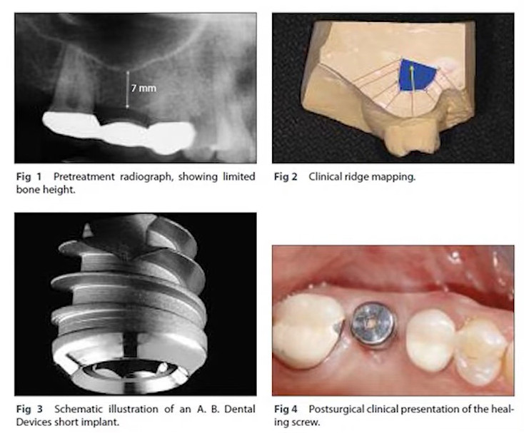 Four panel sequence showing pretreatment radiograph, ridge mapping, short implant design, and healing screw placement