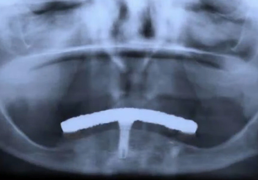Single dental implant supporting full denture showing undesirable configuration