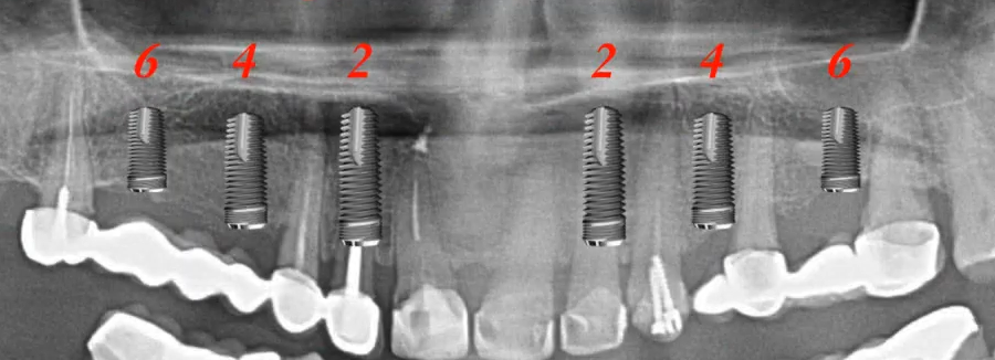 Panoramic x-ray showing six dental implants positioned at locations 2, 4, and 6 in upper jaw