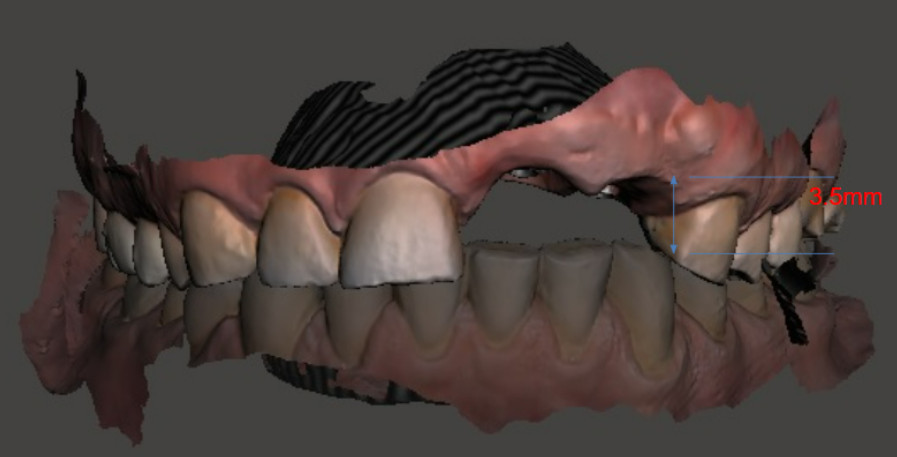 3D image in lateral projection, where the small distance between the lower tooth and the gingiva of the upper jaw is visible