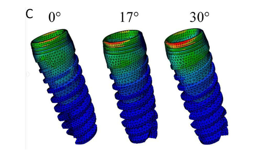 The stress distribution of the implant of the MUA-implant complex with different abutment angulation (0°, 17° and 30°). A, The stress distribution of implants under loading condition A, B. The stress distribution of implants under loading condition B.C, The stress distribution of implants under loading condition C. Research Square/ rs-4446322/v1/ Dong Lin/ Jun 2024
